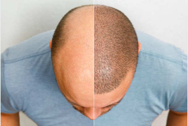 Hair Transplantation In Hyd