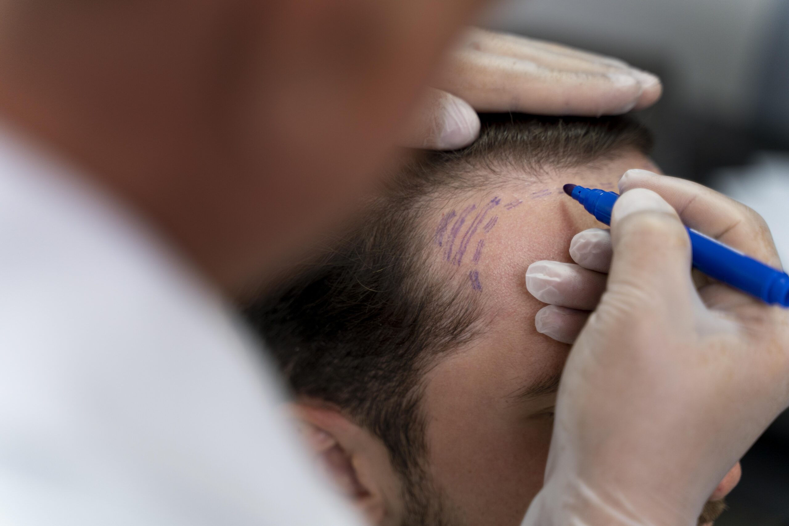 Hair Transplantation In Hyderabad