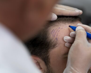 Best Hair Transplantation in Hyderabad